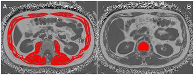 Association between type 2 diabetes mellitus and body composition based on MRI fat fraction mapping